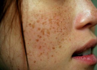 Treat Brown Spots