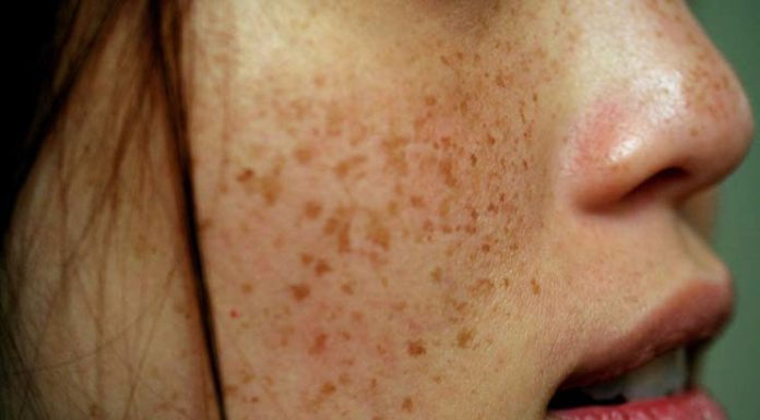 Treat Brown Spots