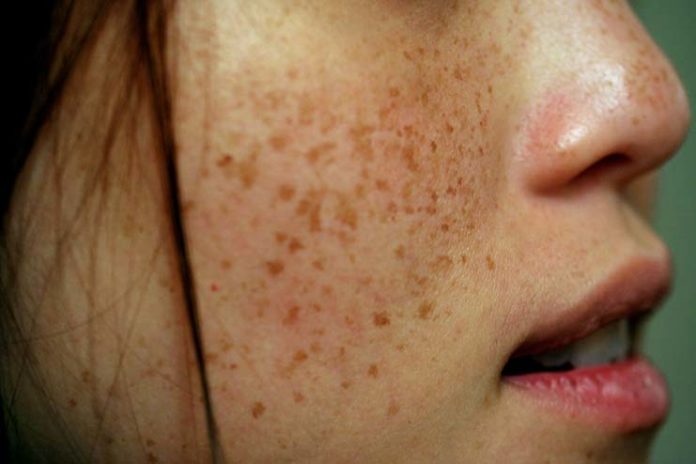 Treat Brown Spots