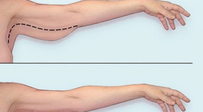 Flabby Arms