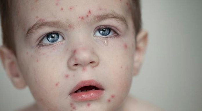 Chicken Pox Scars