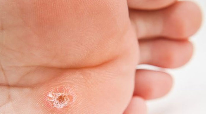 Warts
