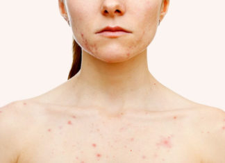 Body acne