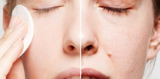 Enlarged pores