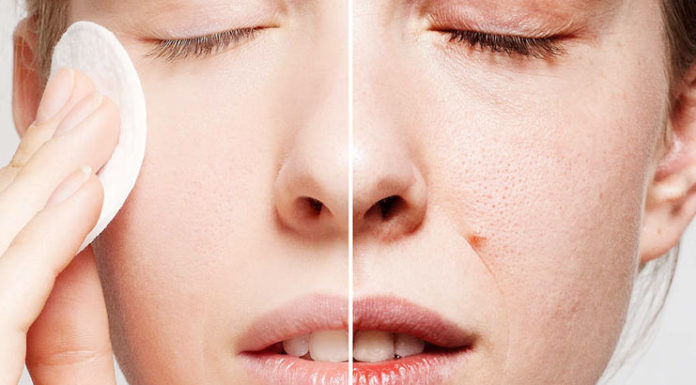 Enlarged pores