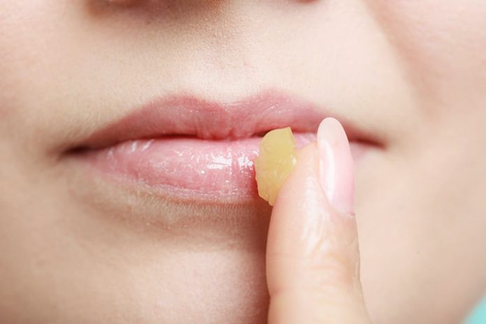 Swollen Lips