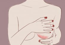 Rashes under the breast