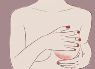 Rashes under the breast