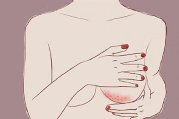 Rashes under the breast