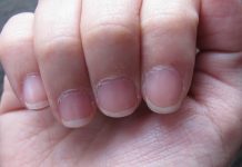 Dry-cuticles