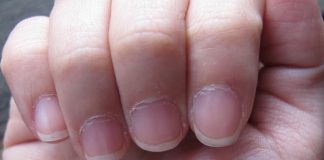 Dry-cuticles