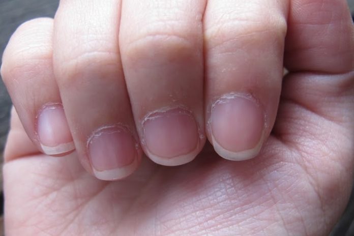 Dry-cuticles