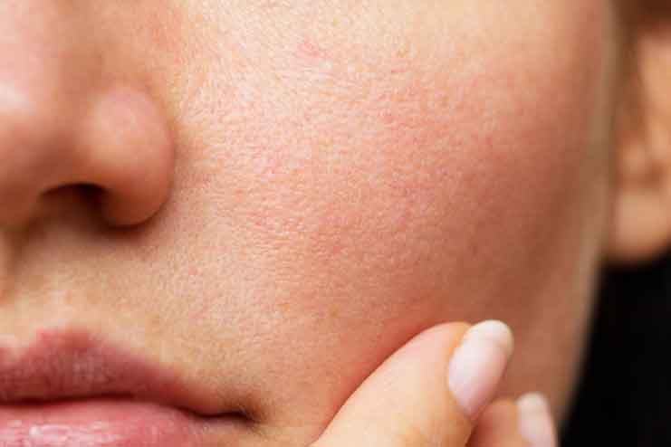 What-Causes-Pores-on-Face