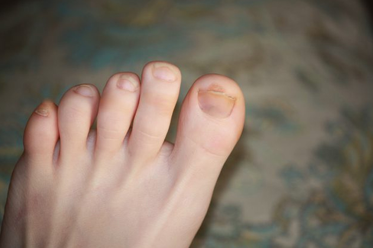 7 Home Remedies For Fungus In Toenails With Causes And Additional