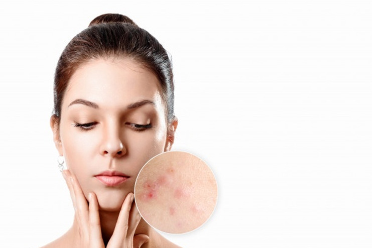 Avoids-acne