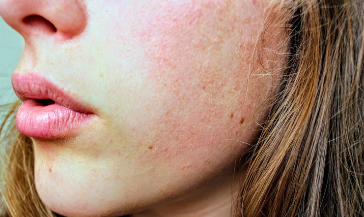 Best-diet-for-dry-skin