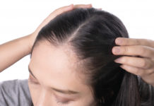 Home-remedies-to-treat-hairline-acne