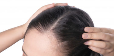 Home-remedies-to-treat-hairline-acne