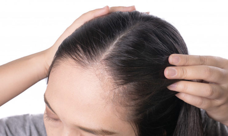 Home-remedies-to-treat-hairline-acne
