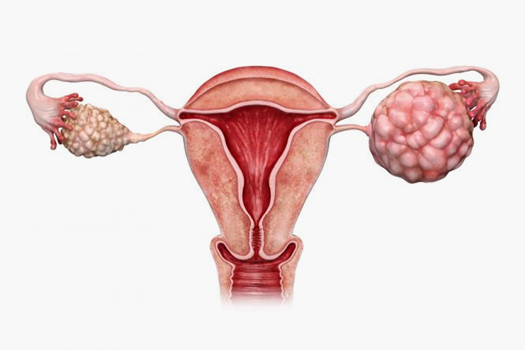 Ovarian-cancer
